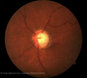 Glaucomatous optic disc