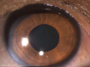 A normal eye with a clear crystalline lens