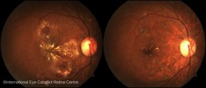 Diabetic retinopathy before (left) and after (right) serial Lucentis eye injections and laser therapy