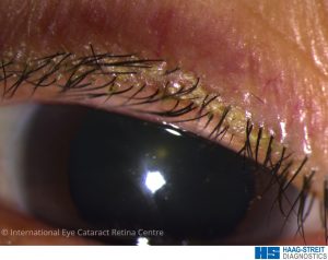Blepharitis causing a build-up of a biofilm and crusting on the eyelid margin near the base of eyelashes
