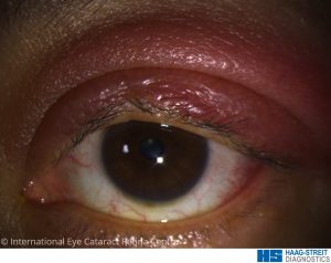 Redness and swelling of the upper eyelid due to inflammation caused by blepharitis