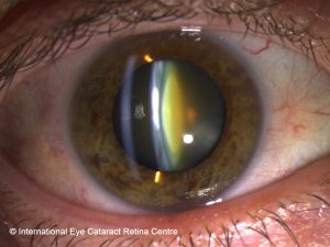 Cataract risk is increased by two to three times in smokers compared to non-smokers