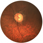 Pterygium
