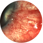 Glaucoma