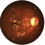 Macular Degeneration