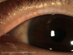 meibomian gland clogged