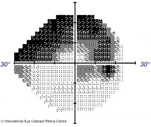 Glaucomatous visual field
