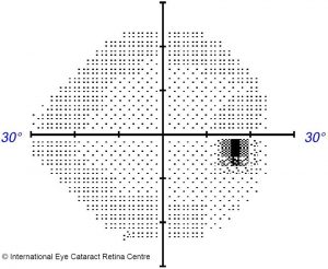 Normal visual field