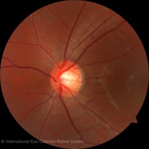 Normal optic disc