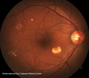 Dry Type Age-related Macular Degeneration