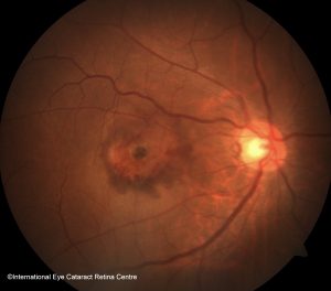 Wet Type Age-related Macular Degeneration