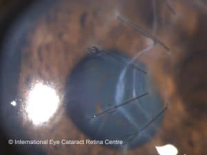 Injury to the cornea can cause impairment of vision
