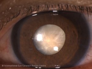 Mature cataract