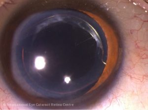 Eye with an intraocular lens implant after cataract surgery