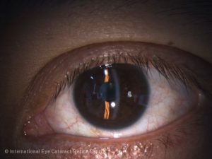 Normal eye without pterygium