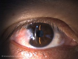 A pterygium covering part of the cornea and threatening vision