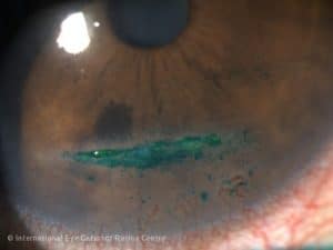 Severe corneal erosions can occur due to dry eye
