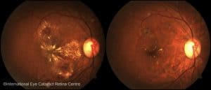 Diabetic retinopathy before (left) and after (right) serial Lucentis eye injections and laser therapy