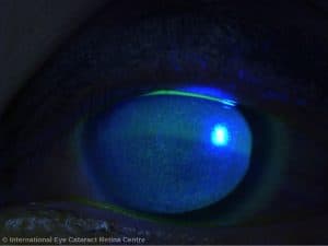 Severe corneal punctate keratitis can occur due to contact lens overwear