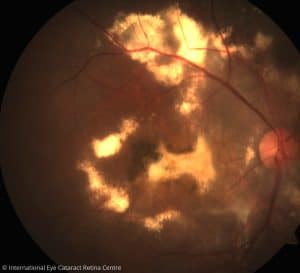 Smoking increases the risk of age-related macular degeneration by three- to four-fold