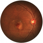 Diabetic Retinopathy
