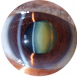 Cataract