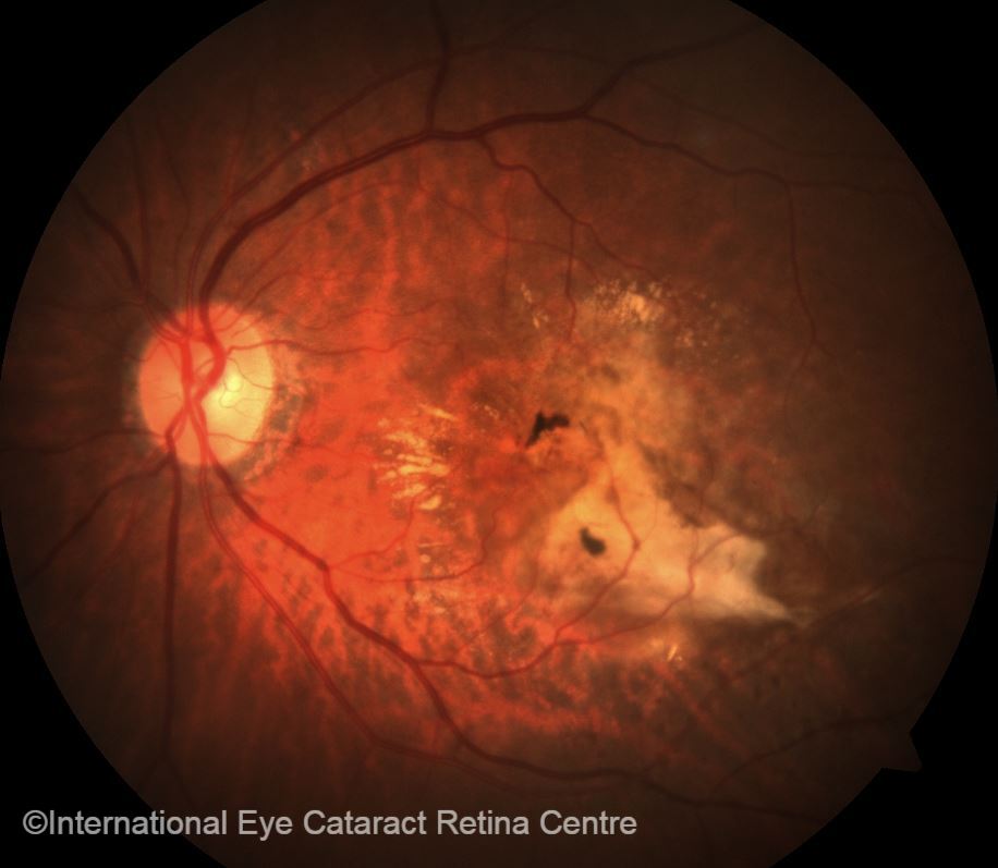 age related macular degeneration